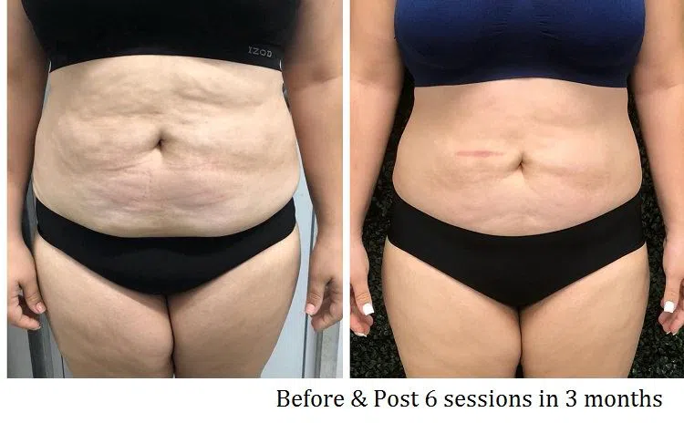 Cellulite Before Afte 1 Cellulite Before Afte 1