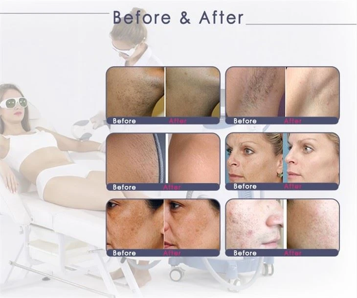 Multifunction Ipl Elight Ipl Super Hair Removal Laser Machine